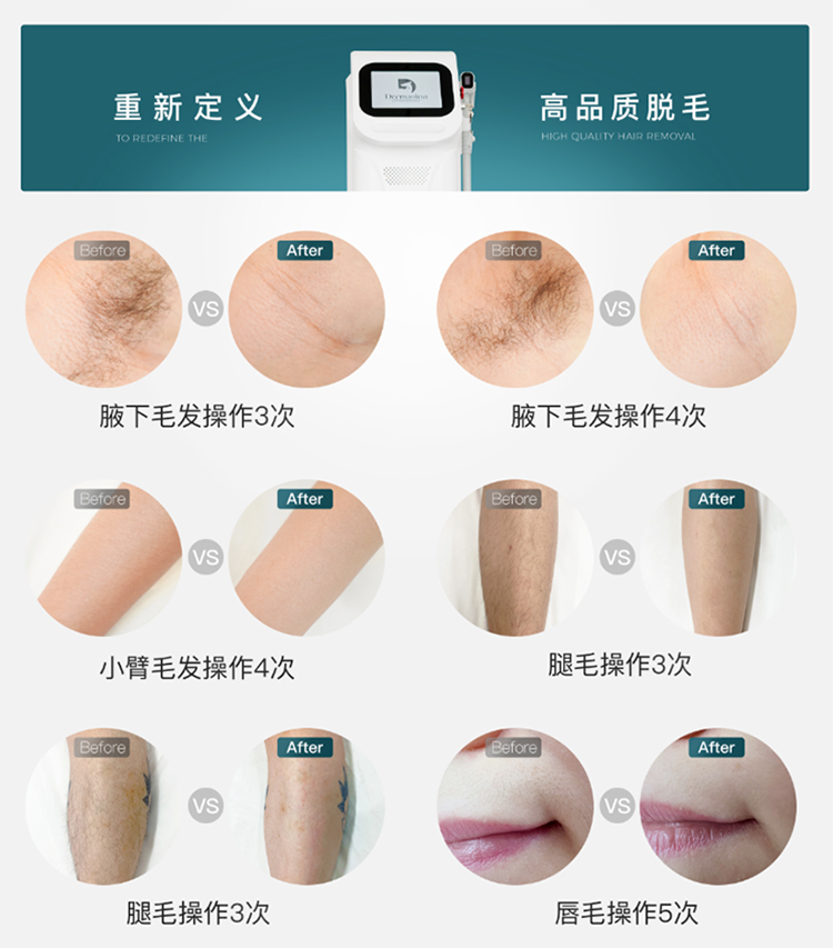 808半導體激光脫毛儀.3.jpg