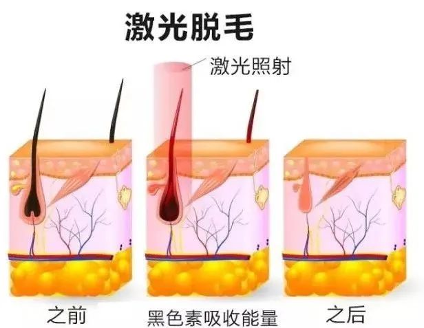 808半導體激光冰點(diǎn)無(wú)痛脫毛儀.jpg
