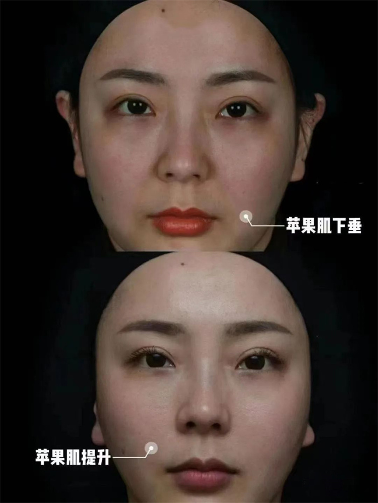 btl溶脂刀.1.jpg